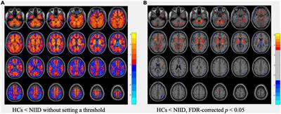 Characteristic cerebral perfusion pattern in neuronal intranuclear inclusion disease